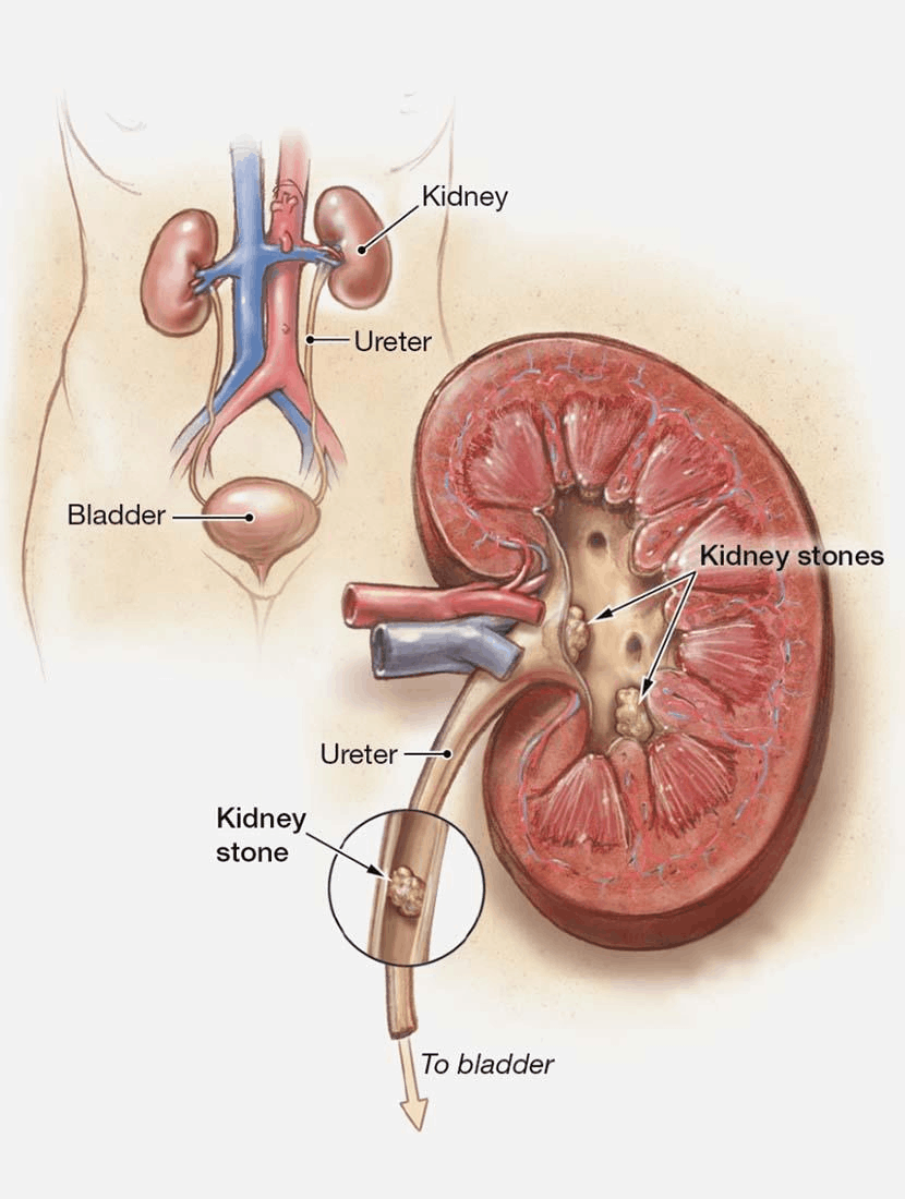 Kidney stone care